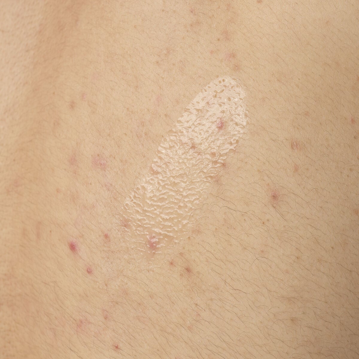 salicylic-acid-0-5-body-serum-e9 ORD-salicylic-acid-05-body-240ml-application.jpg