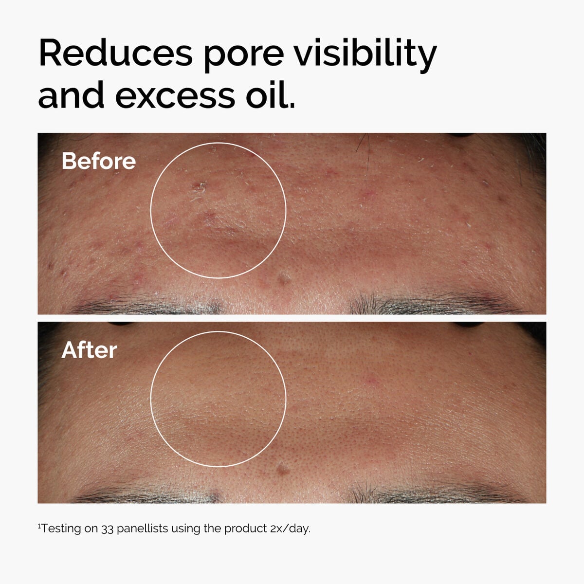 niacinamide-10-zinc-1-r7 ord-niacinamide-zinc-blemish-serum-before-after-pores.jpg
