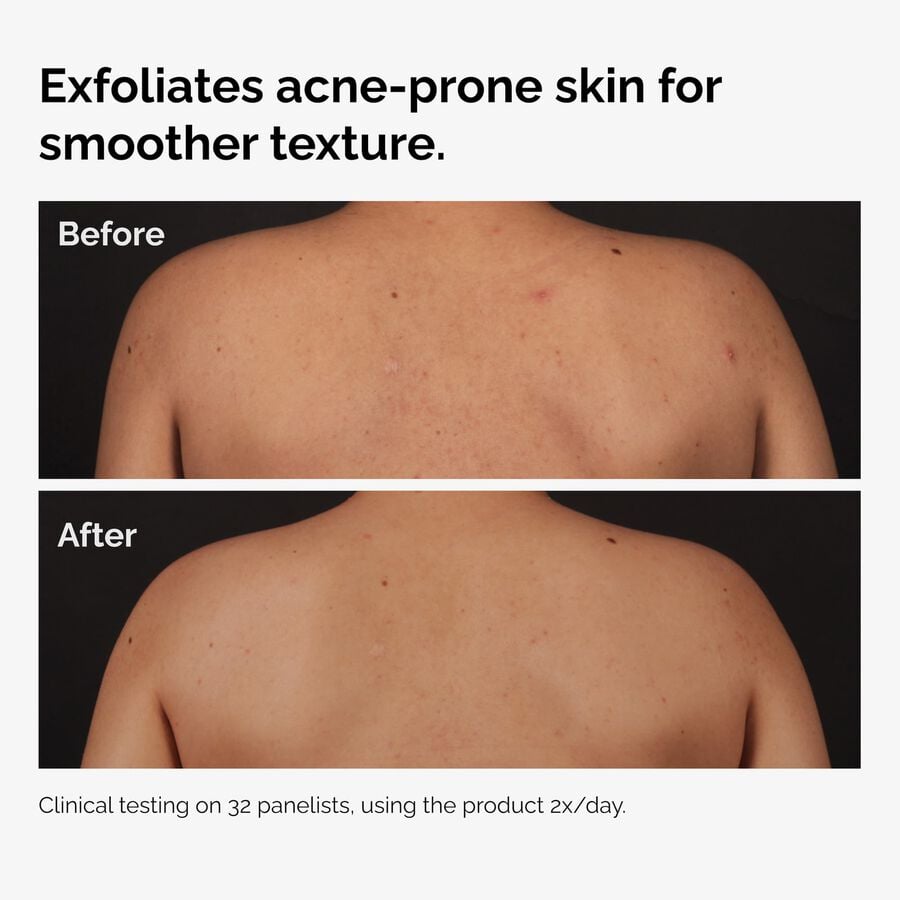 the-body-care-collection-h2 ord-salicylic-acid-body-serum-before-after-graphic-NA.jpg